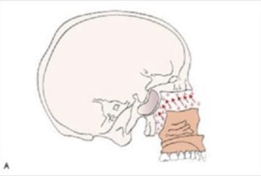 <p>What kind of growth is shown in this figure?</p><p>A. Appositional growth </p><p>B. Sutural growth </p><p>C. Endochondral growth </p><p>D. Intramembranous growth</p>