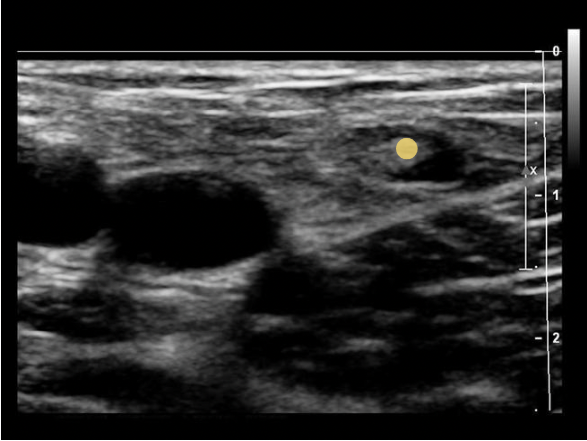 <p>A normal lymph node is oval in shape and demonstrates a thin hypoechoic rim of tissue around an echogenic hilum. Abnormal lymph nodes demonstrate a more rounded shape, thickened cortex that can appear anechoic. and there is loss of differentiation of the hilum.</p>