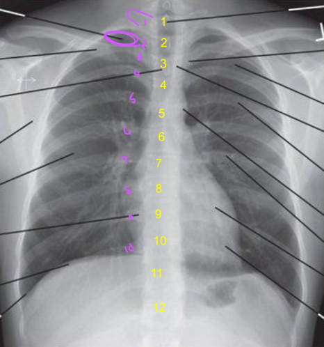 <ul><li><p>Manubrium superimposed by T4</p></li><li><p>1” of apices above clavicles</p></li></ul><p></p>
