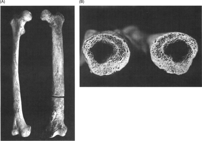 <p>a bacterial infection of the periosteum</p>