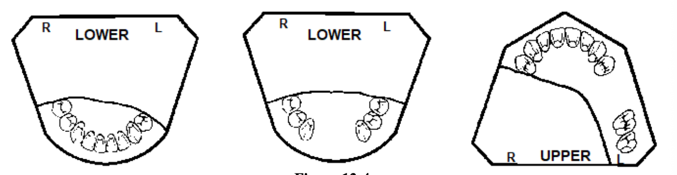<ol><li><p>Take an alginate impression</p></li><li><p>Put Play-Doh in areas that would lock the cast in (blockout)</p></li><li><p>Pour up tooth portion with Die-Keen (do not include distal extension areas)</p></li></ol><p></p>