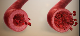 <p>When the insult to the tissue occurs there may be a few seconds of <strong>vasoconstriction</strong></p><p>This is followed by <strong>vasodilation</strong></p><p>First the arterioles dilate opening new capillary beds in the region</p><p>• Allows <u>increased blood flow to the tissue</u></p><p>• Causes <u>erythema </u>(heat and redness) at the site</p><p>Vasodilation is induced by <u>histamine and nitric oxide </u>(NO) acting on the smooth muscle of the vessels</p>