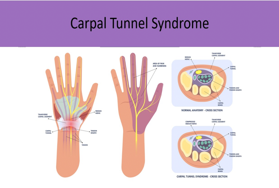 <p>C. Compression of the median nerve by the carpal sheath causing numbness, weakness and pain</p><p class="p1">Carpal tunnel syndrome refers to compression of the median nerve by the carpal sheath causing numbness, weakness and pain in the wrist/hand.</p>