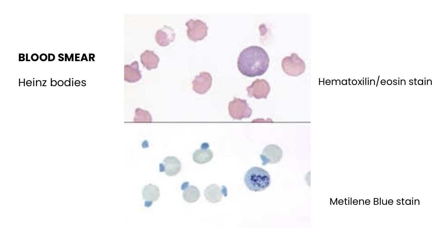 <p>What kind of anemia?</p>