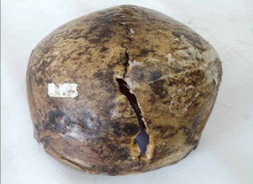 <p>Questions</p><ol><li><p>What is the specimen being examined?</p></li><li><p>What are the type and descriptive features of the fracture?</p></li><li><p>What type of causative instrument produces this injury?</p></li><li><p>How is the time of death estimated?</p></li><li><p>What are the possible causes of death?</p></li><li><p>What is the final diagnosis for this specimen?</p></li></ol><div data-type="horizontalRule"><hr></div><p></p><p></p>