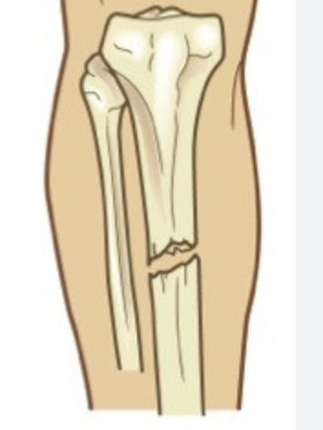 <p>Fracture without communication with the external environment caused by <strong>blunt trauma</strong>, has a <strong>lower infection risk</strong> than an open fracture.</p>