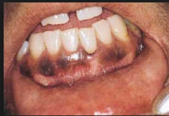 <p>normal pigmentation (darker-black). Common in darker skinned individuals.</p>