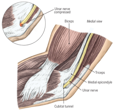 <ul><li><p><span>Numbness and tingling in ring and small fingers</span></p></li><li><p><span>Increased pressure and tension on the ulnar nerve with elbow in a flexed position</span></p></li></ul><p></p><p>-</p><ul><li><p><span>happens when the ulnar nerve </span>compressed, stretched, or irritated as it passes through the inside of the elbow.</p></li><li><p> Common causes include prolonged elbow flexion, leaning on the elbow, direct trauma, or underlying conditions like arthritis or bone spurs</p></li></ul><p></p>