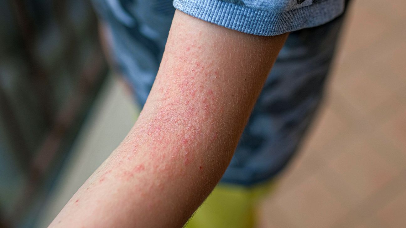 <p>What is atopic dermatitis?</p>