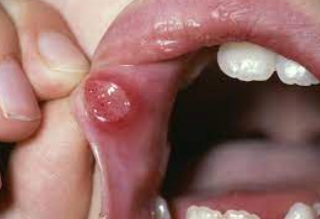 <p>non- infectious, recurring ulcers of the oral mucosa, often associated with stress or immune response.</p>