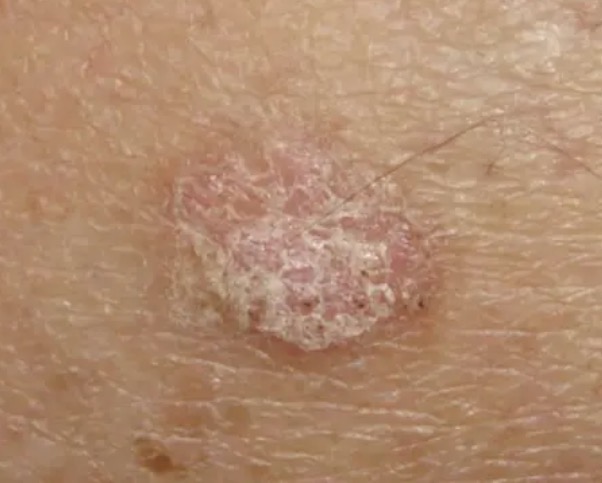 <ul><li><p>precancerous</p></li><li><p>Rough, scaly, crusty patches on sun-exposed skin</p></li></ul><p></p>
