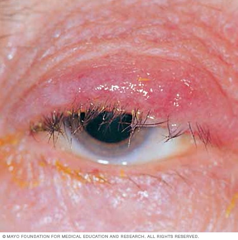 <p>inflammation of glands and eyelash follicles on the margin of the eyelids </p>