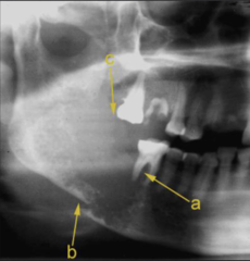 <p>How is this lesion described in terms of periphery?</p>