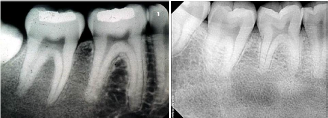 <p>fibrous dysplasia radiographic characteristics</p>