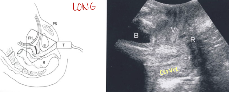 <ul><li><p>alternative technique for assessing cervical length</p></li><li><p>curvilinear transducer placed over labia</p></li><li><p>less accurate than TV technique</p></li></ul><p></p>