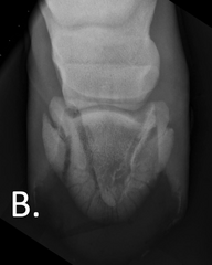 <p>Which fracture type is this?</p>