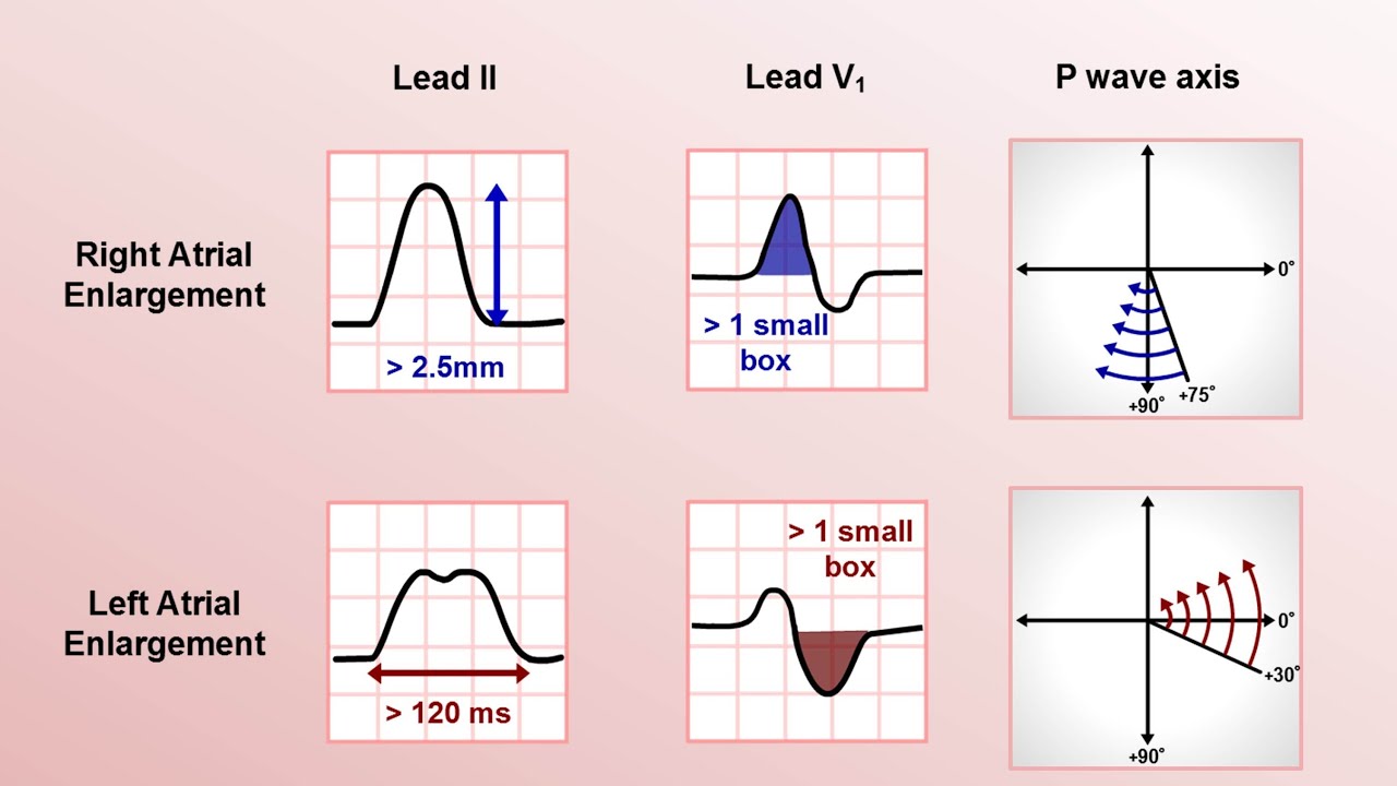 <p>Right atrial enlargement</p>