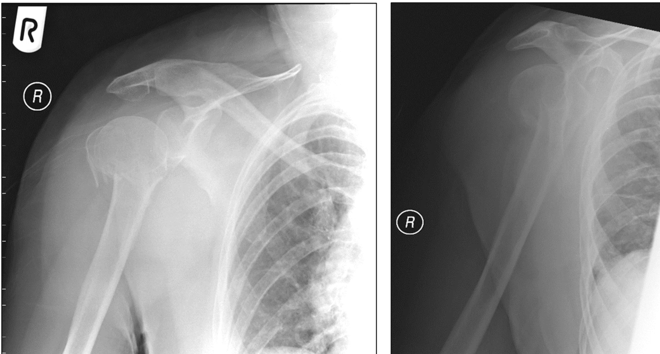 <ul><li><p><span>Communuted - multiple fragments</span></p></li><li><p><span>The humeral head is moving medially and superiorly</span></p></li></ul><p></p><p></p>
