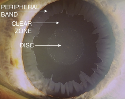 <p>The classic pattern includes:</p><ul><li><p>Central disc of material</p></li><li><p>Clear zone</p></li><li><p>Peripheral band of exfoliative material</p></li></ul><p></p>