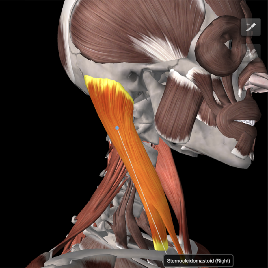 <p>sternocleidomastoid</p>