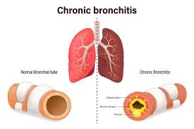 <p>Where the bronchi and bronchioles are clogged with mucus. Caused by smoking.</p>
