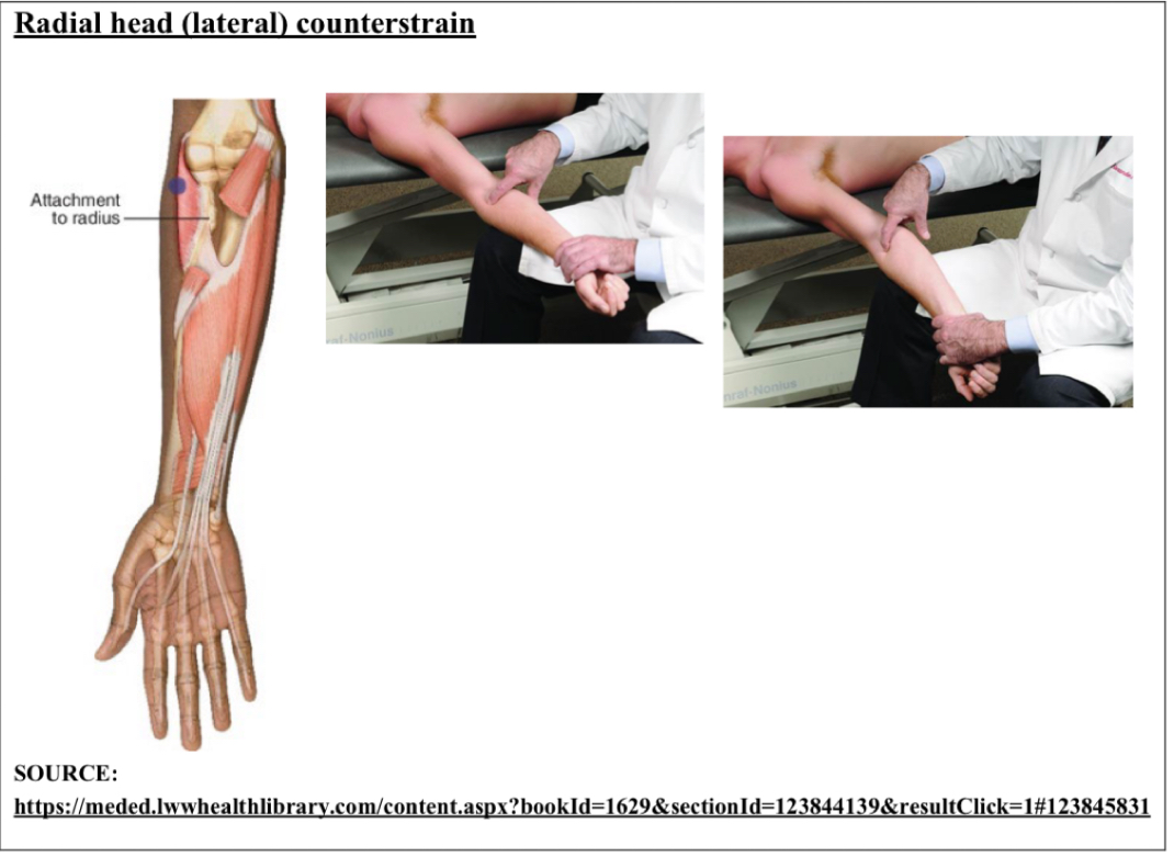 <p>E Sup Val</p><p>Point is anterolateral aspect of radial head at attachment of supinator</p><ol><li><p>pt supine, physician same side as point</p></li><li><p>pt elbow in full extension, forearm supinated</p></li><li><p>fine tune w/ supination and valgus force</p></li></ol><p></p>