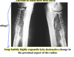 <p>Thyroid or renal Mets</p>