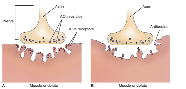 <ul><li><p>Autoimmune disorder where antibodies directed at acetylcholine receptor sites impair transmission of impulses at the myoneural junction</p></li><li><p>Characterized by varying degrees of weakness of voluntary muscles (<mark data-color="purple" style="background-color: purple; color: inherit;">purely motor disorder)</mark> â Blocks messaging</p></li><li><p>Manifestations: variable; ocular (diplopia and ptosis); generalized (weakness of facial muscles, swallowing and voice impairment (dysphonia), generalized weakness)</p></li></ul><p></p>
