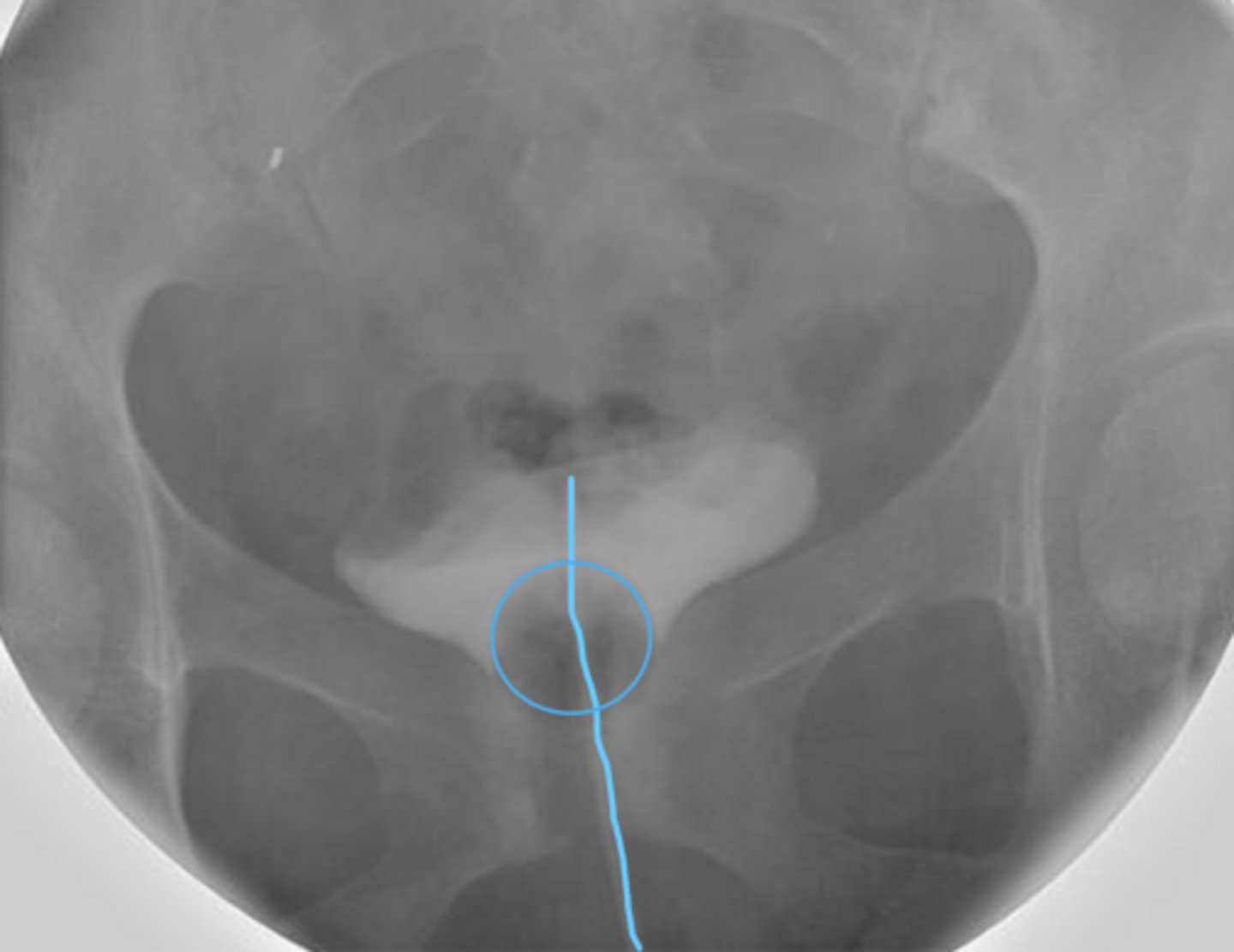 <p>drain bladder</p><p>sometimes to introduce contrast to body</p><p>can be seen when put a contrast in bladder</p><p>don't xray these but can see during pelvis exam</p>