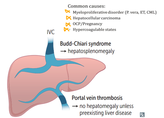 <ul><li><p>hypercoagulable states</p></li><li><p>polycythemia vera</p></li><li><p>postpartum state,</p></li><li><p>HCC</p></li></ul><p>(In HCC my have compression of centrilobular veins) </p>