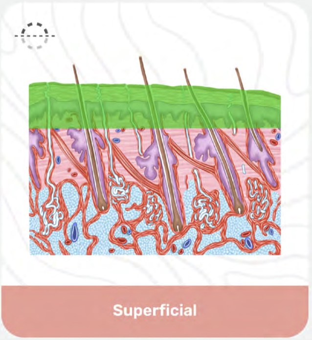 <p>Superficial </p>