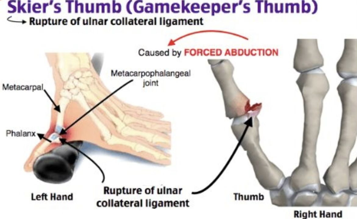 <p>gamekeeper’s thumb symptoms + treatment </p>
