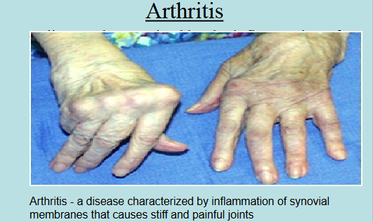 <p>Joint Diseases</p>