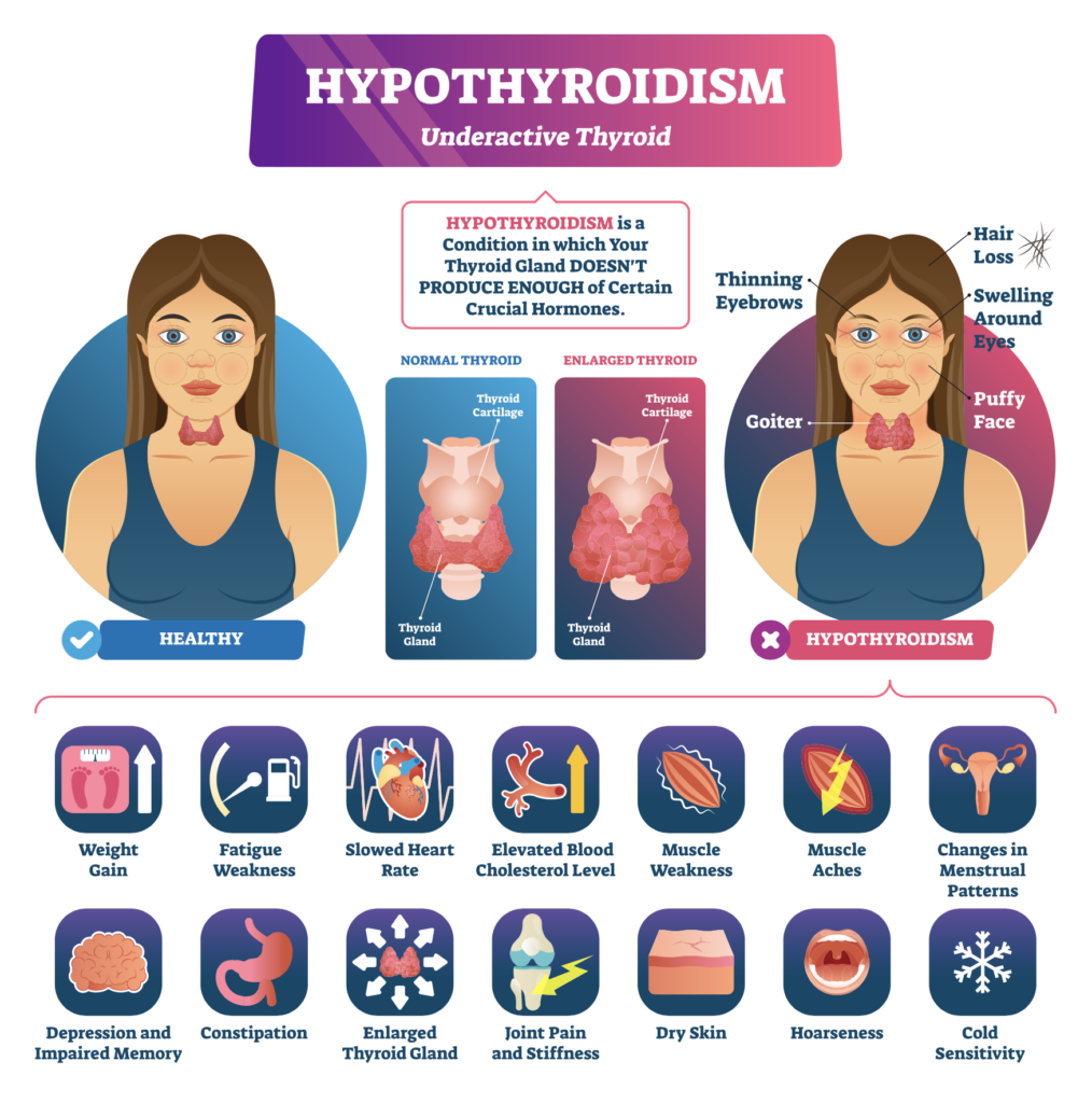 <p>hypothyroidism (definition, S/S, treatment)</p>