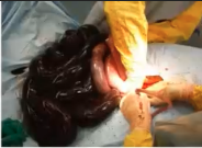 <p>1. Indicates tissue ischaemia. Normal <2 mmol/L. Plasma lactate indicates metabolic state of every body organ, Peritoneal fluid is a ultrafiltrate of plasma.</p><p>2. Peritoneal Lactate > 1.5x plasma lactate suggestive of local production of lactate within the abdominal cavity (e.g. GI Ischaemia)</p>