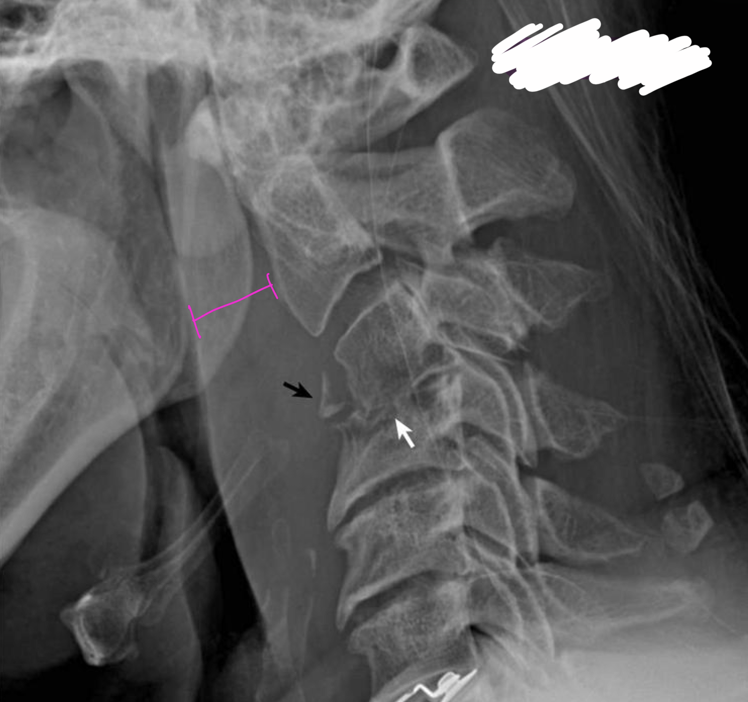 <p>What is the most likely cause of this pt’s increased RPI and RTI</p>