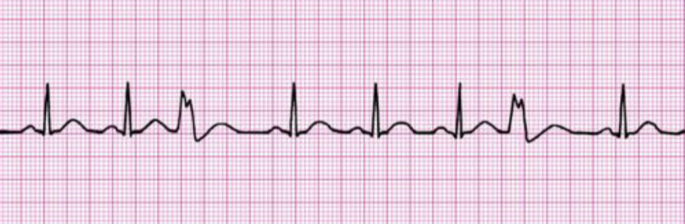 <p>the image shown depicts what cardiac arrhythmia?</p>