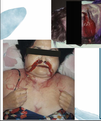 <p>Questions</p><ol><li><p>What postmortem change is characterized by these features?</p></li><li><p>How is the fluid from the mouth and nostrils described during this process?</p></li><li><p>What is the differential diagnosis (D.D.) for this fluid?</p></li></ol><div data-type="horizontalRule"><hr></div><p></p><p></p>
