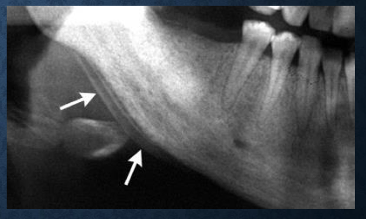 <p>exudate from inflammatory lesion lifts periosteum off of the surface</p><p>when it occurs multiple times, can result in onion-skin appearance</p><p>most commonly seen with osteomyelitis</p><p>less common but can be seen in leukemia and langerhan’s</p>