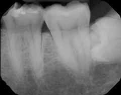 <p>Identify the major placement error in this molar radiograph.</p>