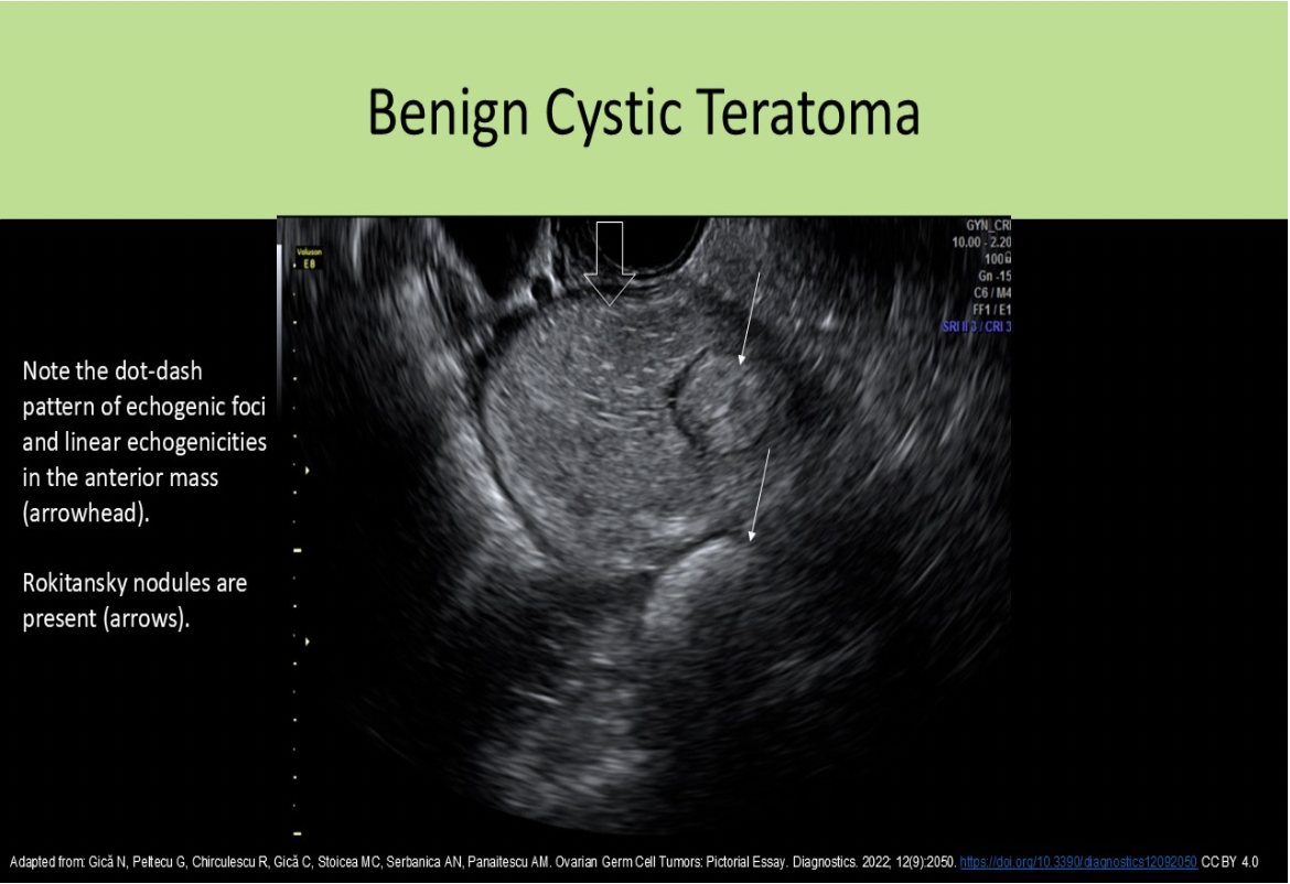 <p>B. benign cystic teratoma</p>