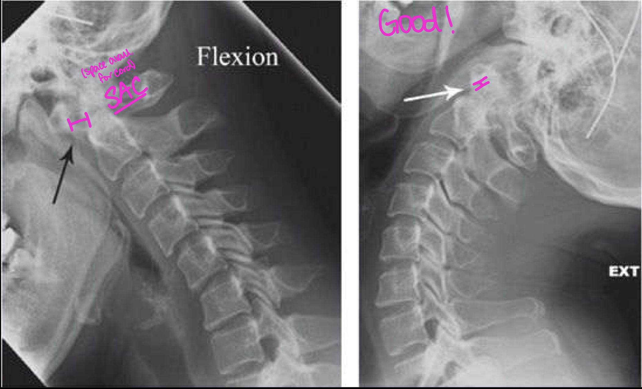 <p>A wider AADI (due to erosions caused by pannus) is bad b/c</p>