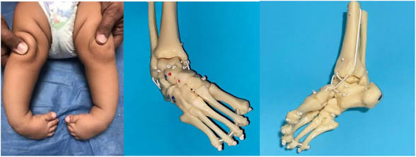 <p>Deformidad en la que el pie se encuentra permanentemente en flexión hacia abajo</p>