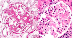 <p>-abnormal deposition of amyloid protein in the kidneys</p><p>-caused by abnormal folding of proteins</p><p>-can lead to proteinuria and progressive renal failure</p>