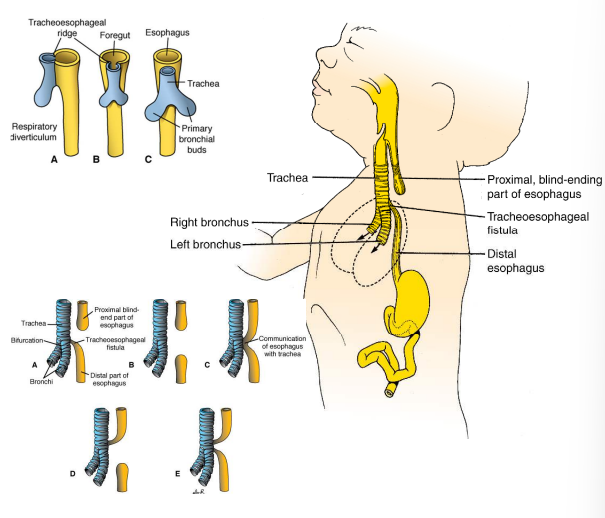 <ol><li><p>fluid (milk) can enter lungs = infection and death</p></li><li><p>blind-ending esophagus prevents swallowing amniotic fluid which is usually returned to the mother via placenta circulation = excess amniotic fluid and distention of the uterus</p></li></ol><p></p>