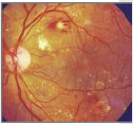 <ul><li><p>Rare before 10 years of age</p></li><li><p>Children should receive annual eye examinations after age 10</p></li></ul><p></p>