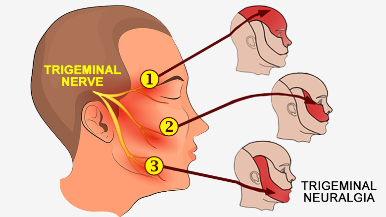 <p>A condition that causes <strong>sudden, severe facial pain</strong> due to <strong>irritation of the trigeminal nerve</strong>.</p>