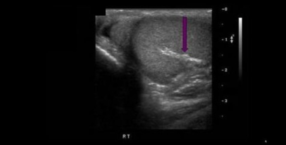 <p>What structure is indicated by the arrow?</p><p>A. appendix teste</p><p class="p1">B. cremasteric ligament</p><p class="p1">C. centripetal ligament</p><p class="p1">D. mediastinum testis</p>