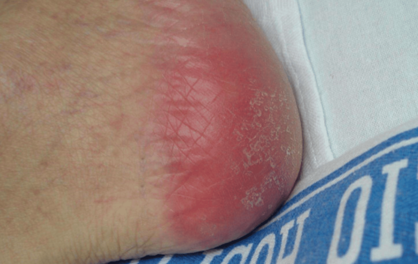 <p>change in skin color/ temp</p><p>persistent red discoloration</p><p>skin is intact</p><p>non blanchable erythema</p>