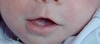<p>What term best describes this patient's lips?</p><p>a) Thick lower lip</p><p>b) Thin upper lip</p><p>c) Downturned corners of the mouth</p><p>d) Thick upper lip</p>
